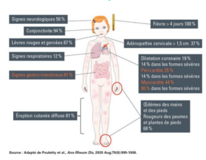 Syndrome PIMS et Covid-19 : symptômes et prise en charge