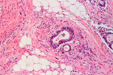 Un nouveau test immunologique de dépistage du cancer colorectal bientôt sur le marché Un nouveau test immunologique de dépistage du cancer colorectal bientôt sur le marché