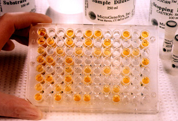 Ajuster le seuil des D-dimères à l’âge augmente la spécificité du dosage chez les plus de 50 ans Ajuster le seuil des D-dimères à l’âge augmente la spécificité du dosage chez les plus de 50 ans