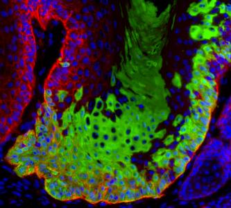 Des cellules souches cancéreuses identifiées pour la première fois in vivo