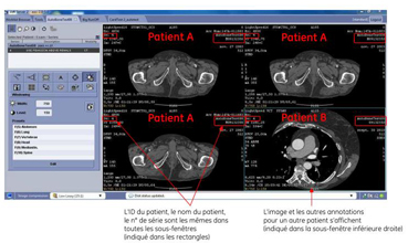 L’application Results Viewer de l’AW Server de GE Healthcare peut mélanger les résultats de deux patients