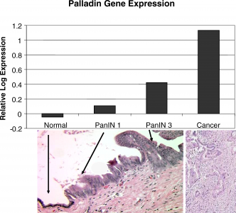 De nouveaux marqueurs pronostiques de survie identifiés dans le cancer du pancréas