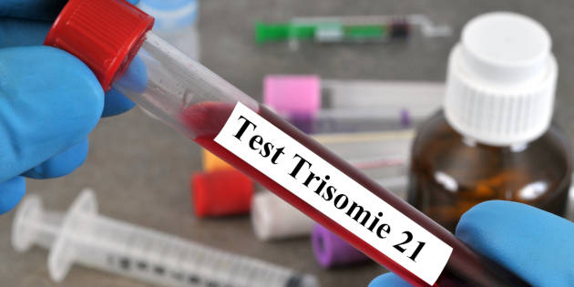 Une simple prise de sang pour le dépistage de la trisomie 21 Une simple prise de sang pour le dépistage de la trisomie 21