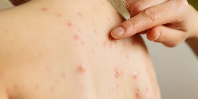 La HAS favorable au remboursement du TAAN pour le diagnostic de la rougeole La HAS favorable au remboursement du TAAN pour le diagnostic de la rougeole