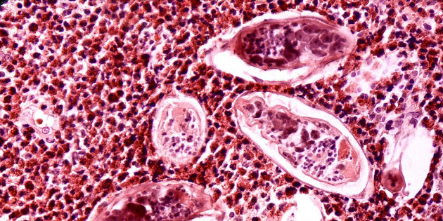 Le Haut Conseil de la Santé publique recommande le dépistage de la bilharziose à Schistosoma haematobium Le Haut Conseil de la Santé publique recommande le dépistage de la bilharziose à Schistosoma haematobium