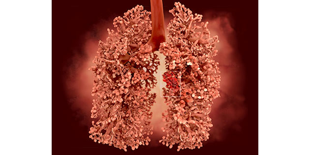 Proposition d’un dépistage actif du cancer bronchique chez les salariés fortement exposés à l’amiante Proposition d’un dépistage actif du cancer bronchique chez les salariés fortement exposés à l’amiante
