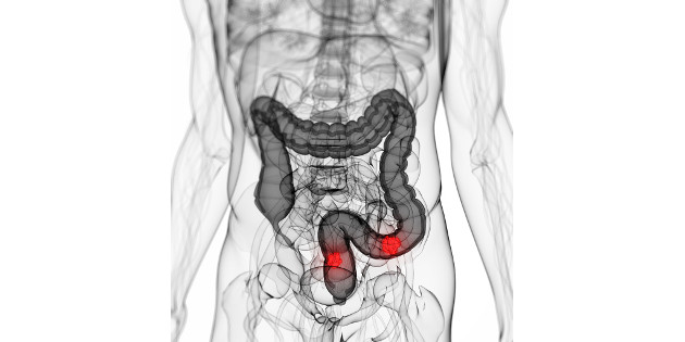 Le rapport plaquettes sur lymphocytes, un marqueur pronostique dans le cancer du côlon