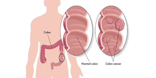 Cancer colorectal : modalités de dépistage et de prévention chez les sujets à risque élevé et très élevé