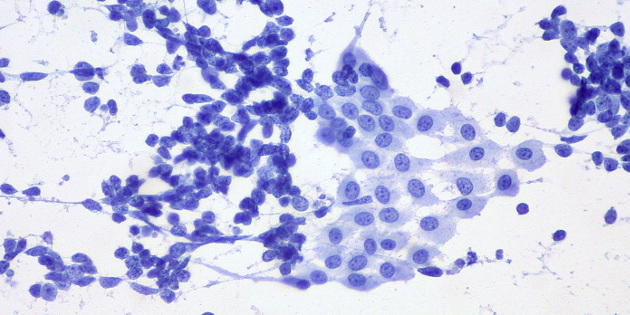 Des cellules sentinelles du cancer du poumon détectées biologiquement plusieurs années avant le diagnostic par imagerie