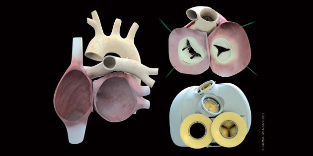 Première implantation du cœur bioartificiel CARMAT