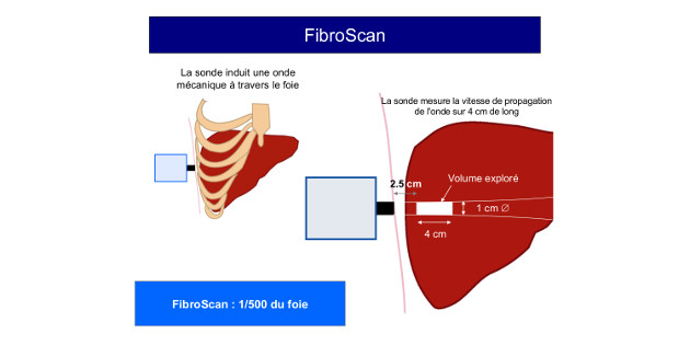 Infection chronique par le VHB : quelle place pour les tests non invasifs de fibrose ? Infection chronique par le VHB : quelle place pour les tests non invasifs de fibrose ?