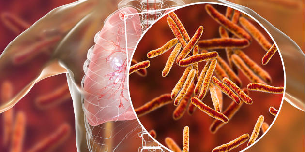 Des souches de tuberculose non détectées par les tests standards