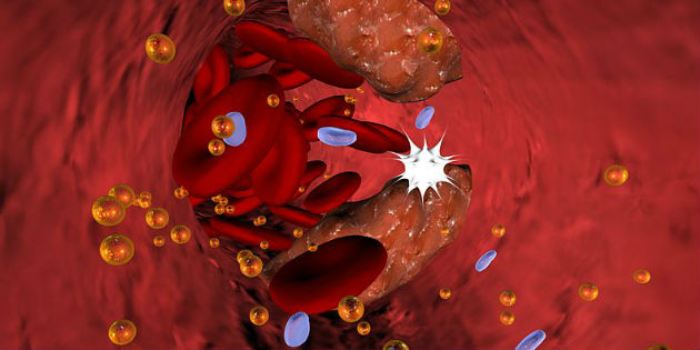 Un biomarqueur prédisant le risque d’instabilité des plaques d’athérome carotidiennes