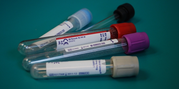 Un test sanguin pour détecter la maladie d’Alzheimer
