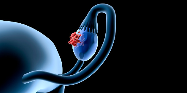 Biomarqueur HE4, indice ROMA : des aides majeures au diagnostic du cancer de l’ovaire