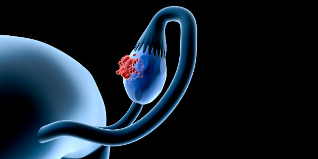 Biomarqueur HE4, indice ROMA : des aides majeures au diagnostic du cancer de l’ovaire Biomarqueur HE4, indice ROMA : des aides majeures au diagnostic du cancer de l’ovaire