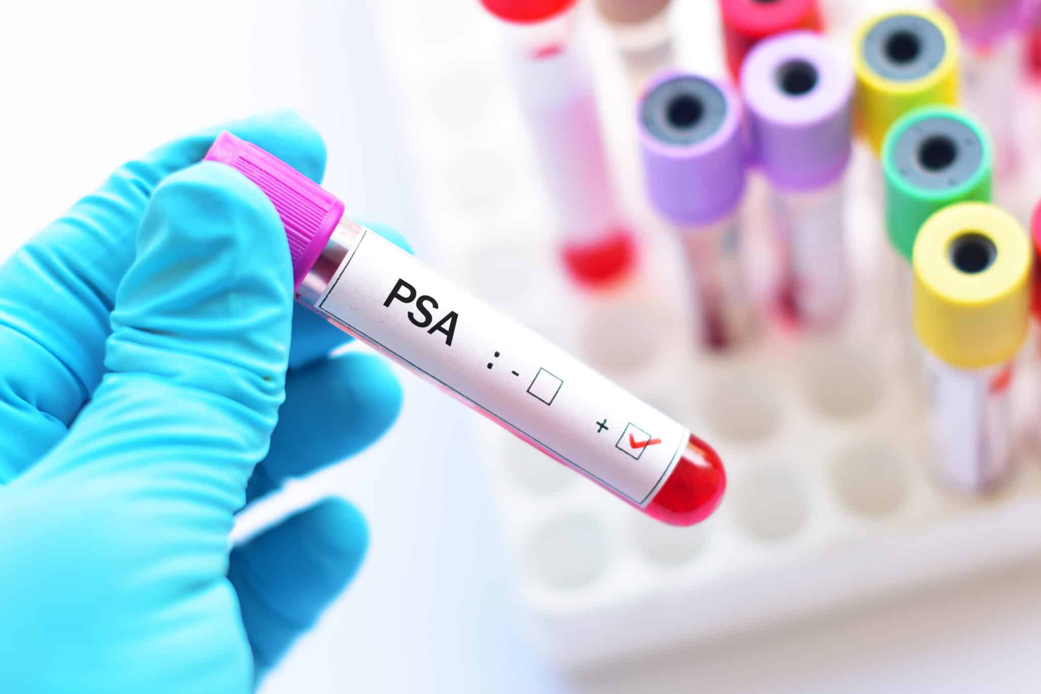 Cancer de la prostate : marqueurs actuels et futurs Cancer de la prostate : marqueurs actuels et futurs