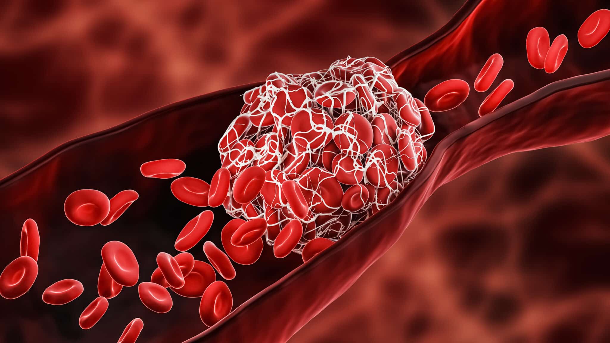 Bon usage des D-Dimères lors d’un diagnostic de MTE