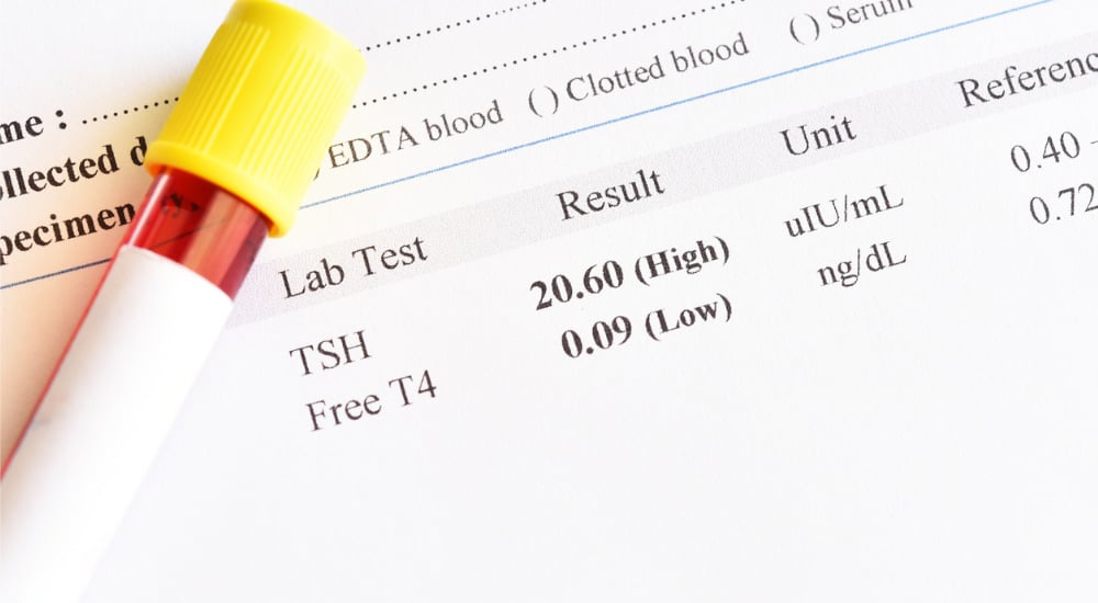 Dysthyroïdies : les nouvelles recommandations de la HAS