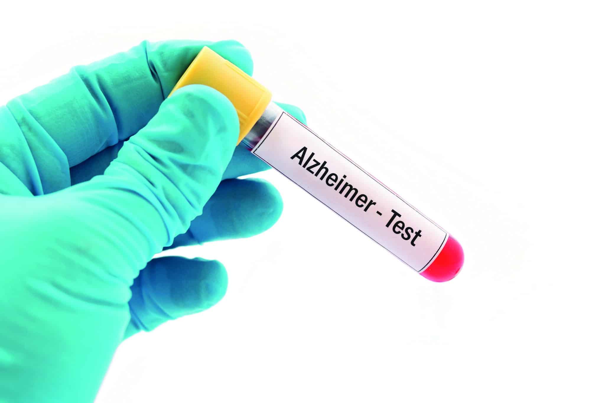 Diagnostic précoce d’Alzheimer : quels biomarqueurs ?