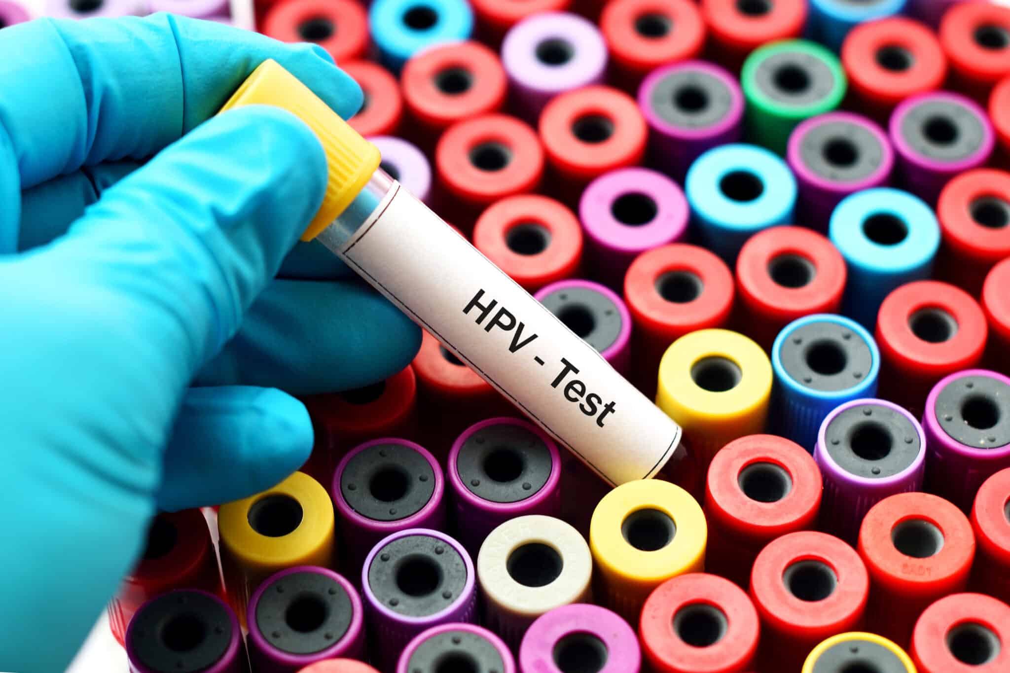 Un test HPV systématique à partir de 30 ans
