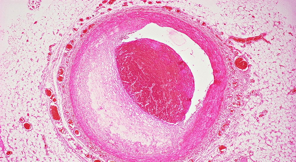 Maladies cardiovasculaires : le rôle du microbiote intestinal exploré