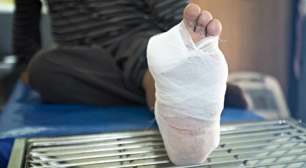 Patient diabétique montrant son pied amputé de deux orteils enveloppé dans un bandage