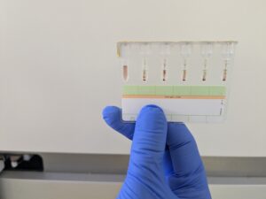 immunohématologie,incompatibilité foetomaternelle,allo-immunisation,anticorps antiérythrocytaire