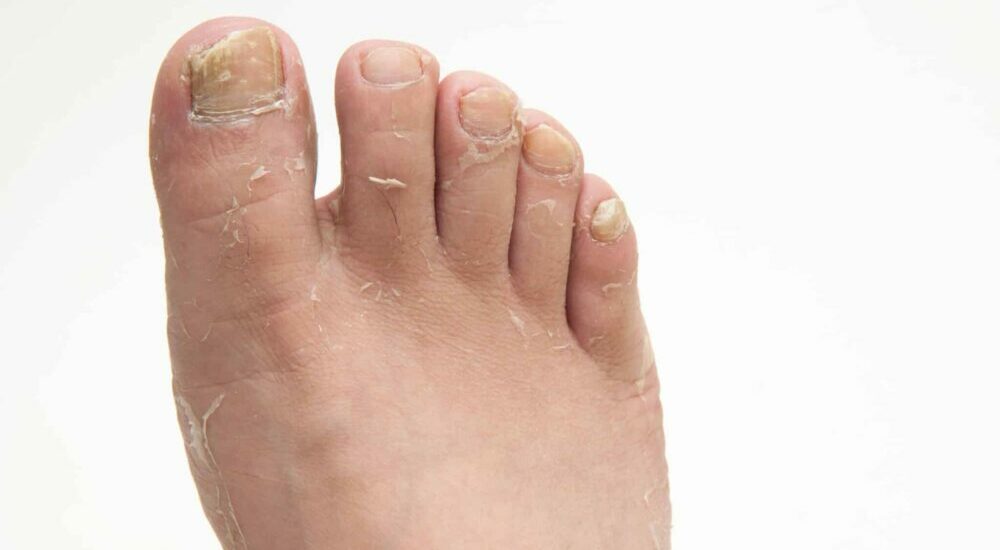 Orteils et peau du pied infectés par des champignons.
