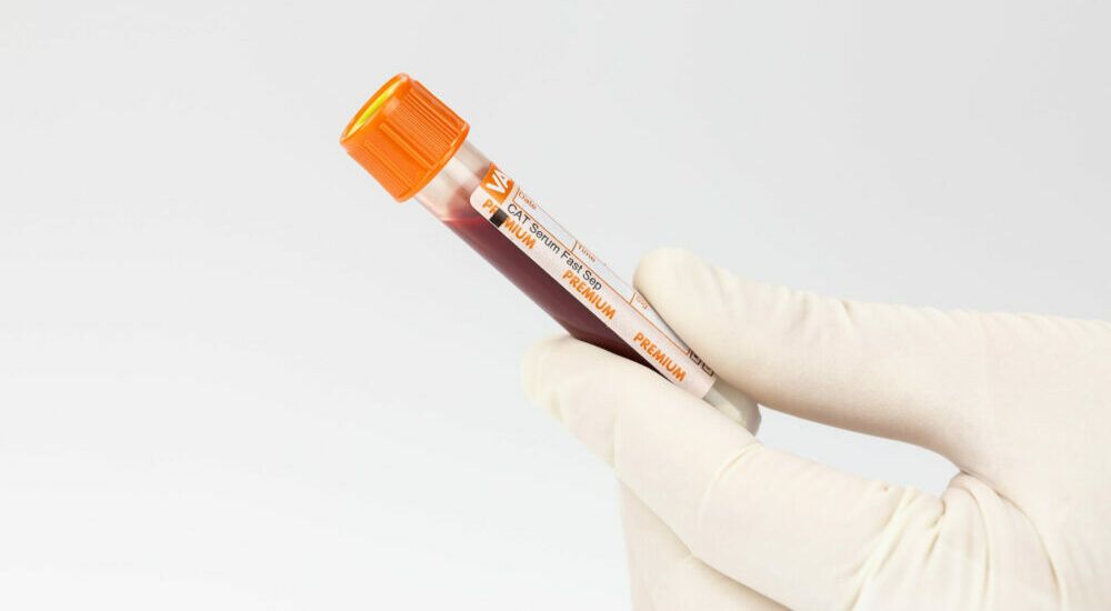 Tube Sérum Fast VACUETTE® : un accélérateur de performance pour le laboratoire Tube Sérum Fast VACUETTE® : un accélérateur de performance pour le laboratoire