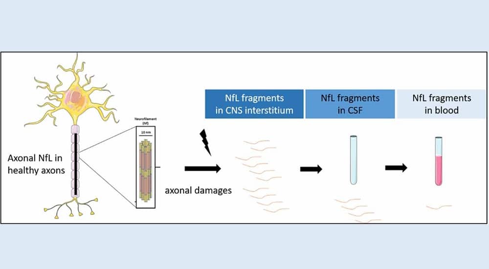 infographie dosage des neurofilament