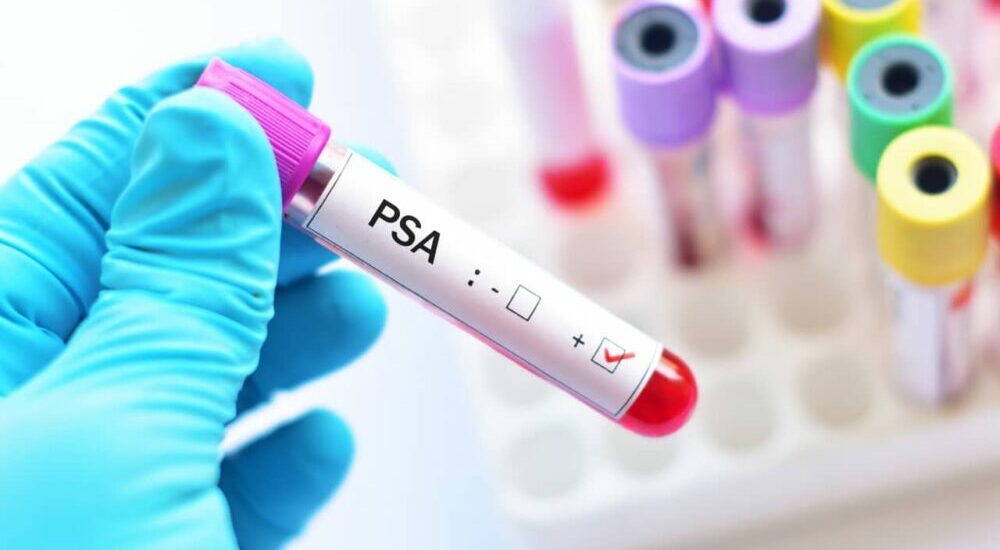 Cancer de la prostate,Cleveland diagnostics,IsoPSA